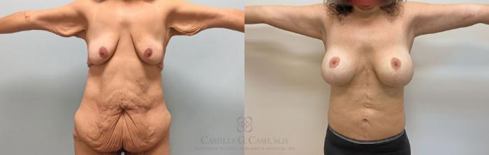 Before & After Post-Weight Loss Body Contouring Case 231 View #1 View in Houston, TX