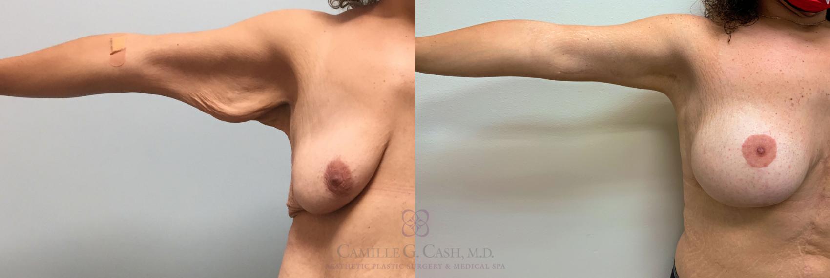 Before & After Post-Weight Loss Breast Enhancement Case 231 View #2 View in Houston, TX