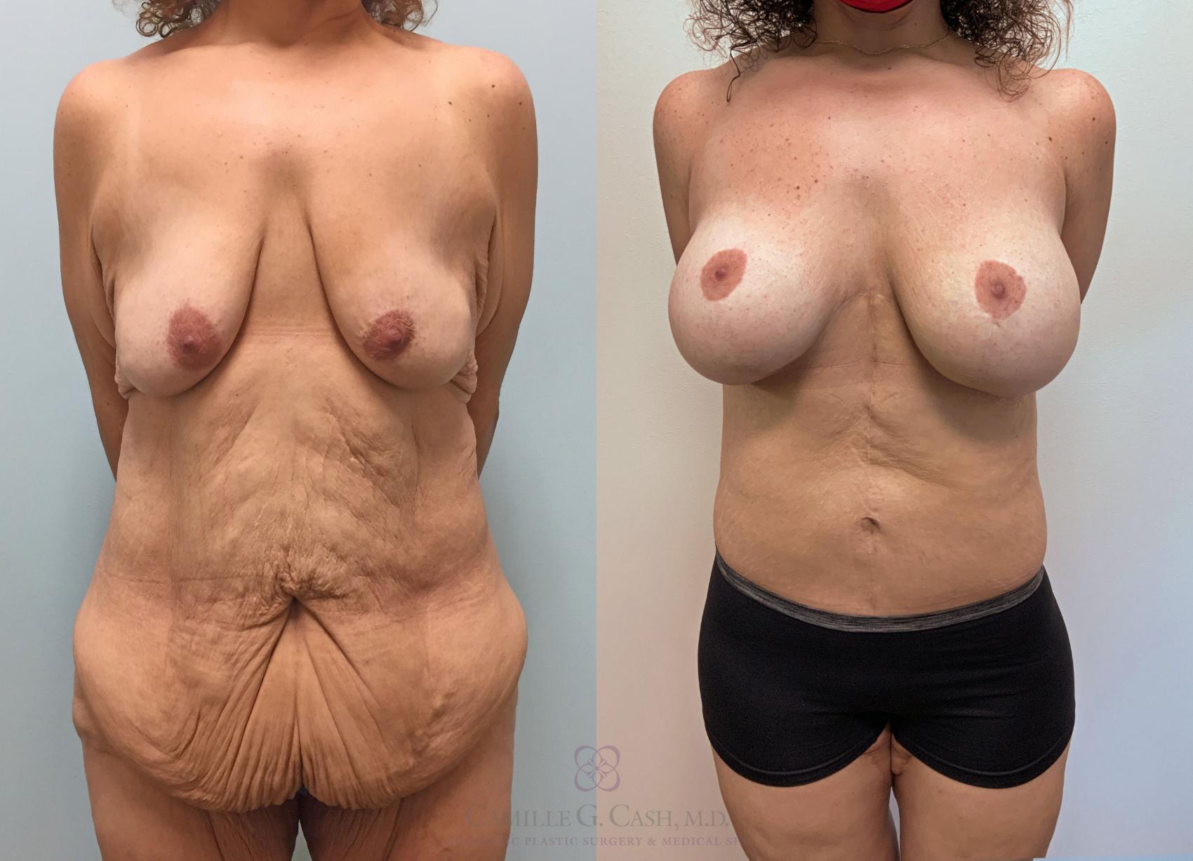 Before & After Post-Weight Loss Breast Enhancement Case 231 View #3 View in Houston, TX