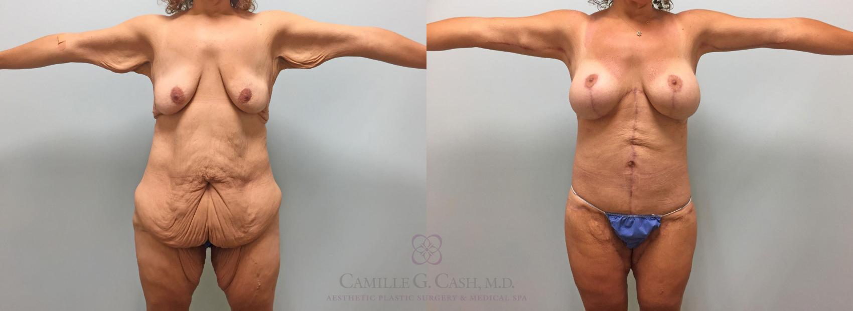 Before & After Post-Weight Loss Breast Enhancement Case 231 View #4 View in Houston, TX