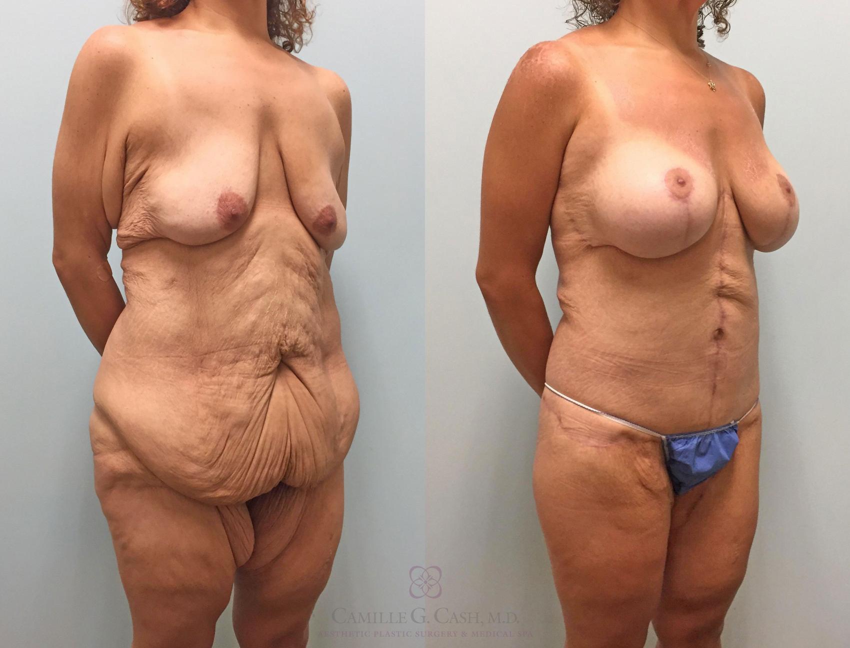 Before & After Post-Weight Loss Body Contouring Case 231 View #5 View in Houston, TX