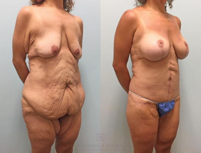Before & After Post-Weight Loss Body Contouring Case 231 View #5 View in Houston, TX