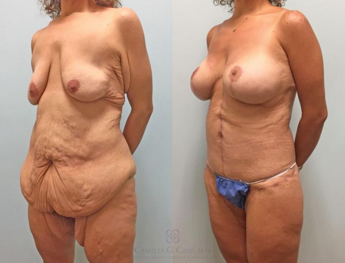 Before & After Post-Weight Loss Breast Enhancement Case 231 View #6 View in Houston, TX
