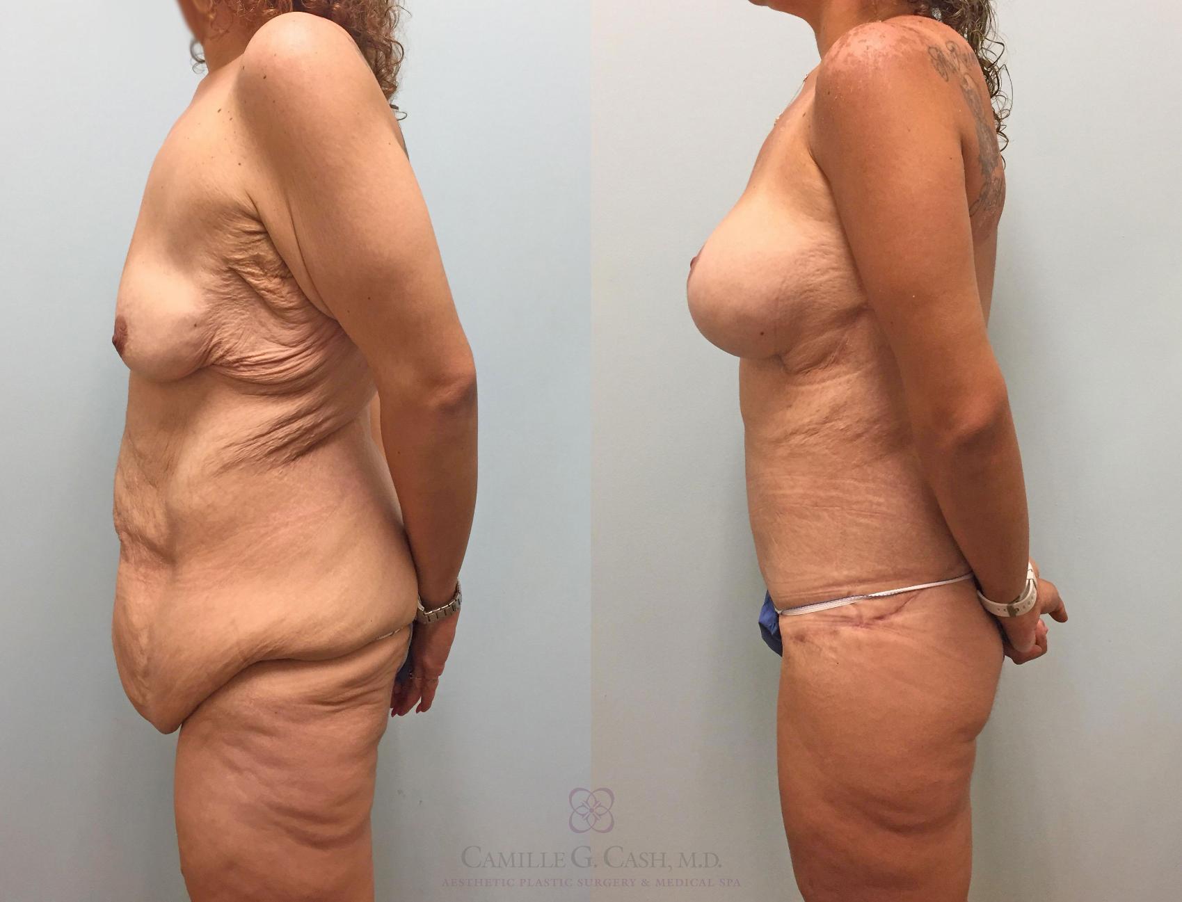 Before & After Post-Weight Loss Body Contouring Case 231 View #7 View in Houston, TX