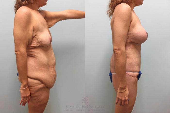 Before & After Post-Weight Loss Body Contouring Case 231 View #8 View in Houston, TX