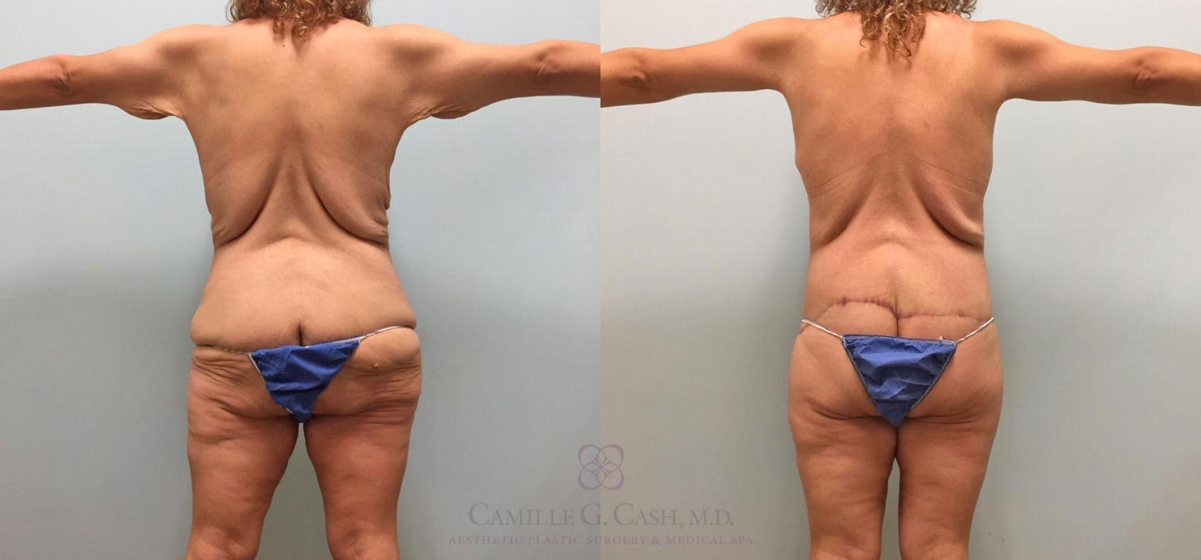Before & After Post-Weight Loss Body Contouring Case 231 View #9 View in Houston, TX