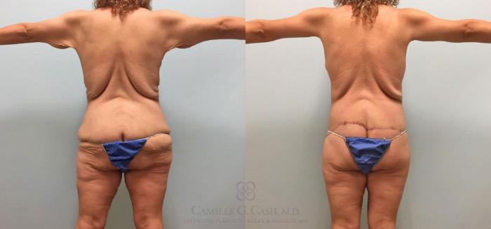 Before & After Post-Weight Loss Breast Enhancement Case 231 View #9 View in Houston, TX