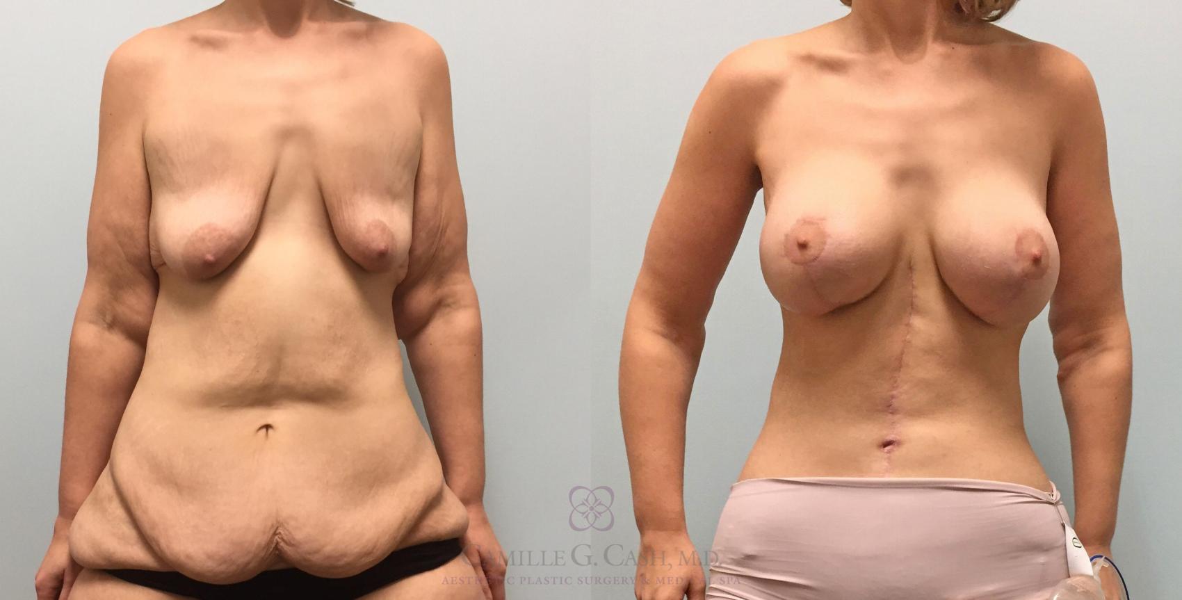 Before & After Post-Weight Loss Breast Enhancement Case 232 View #1 View in Houston, TX