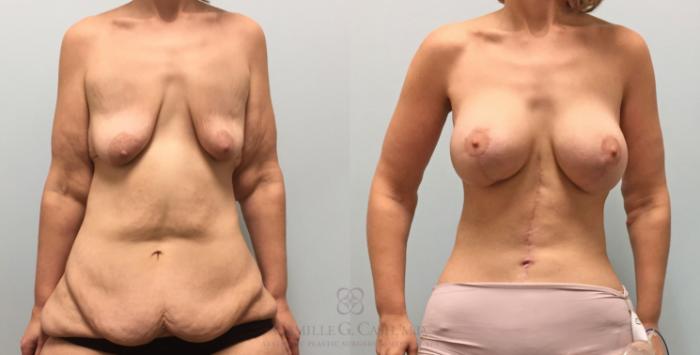Before & After Post-Weight Loss Body Contouring Case 232 View #1 View in Houston, TX