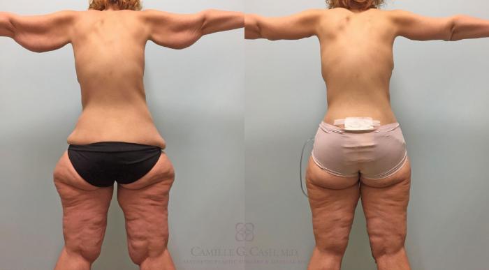 Before & After Post-Weight Loss Breast Enhancement Case 232 View #2 View in Houston, TX