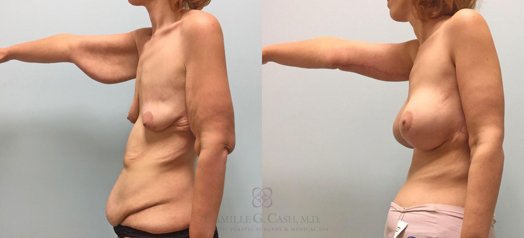 Before & After Arm Lift Case 232 View #3 View in Houston, TX