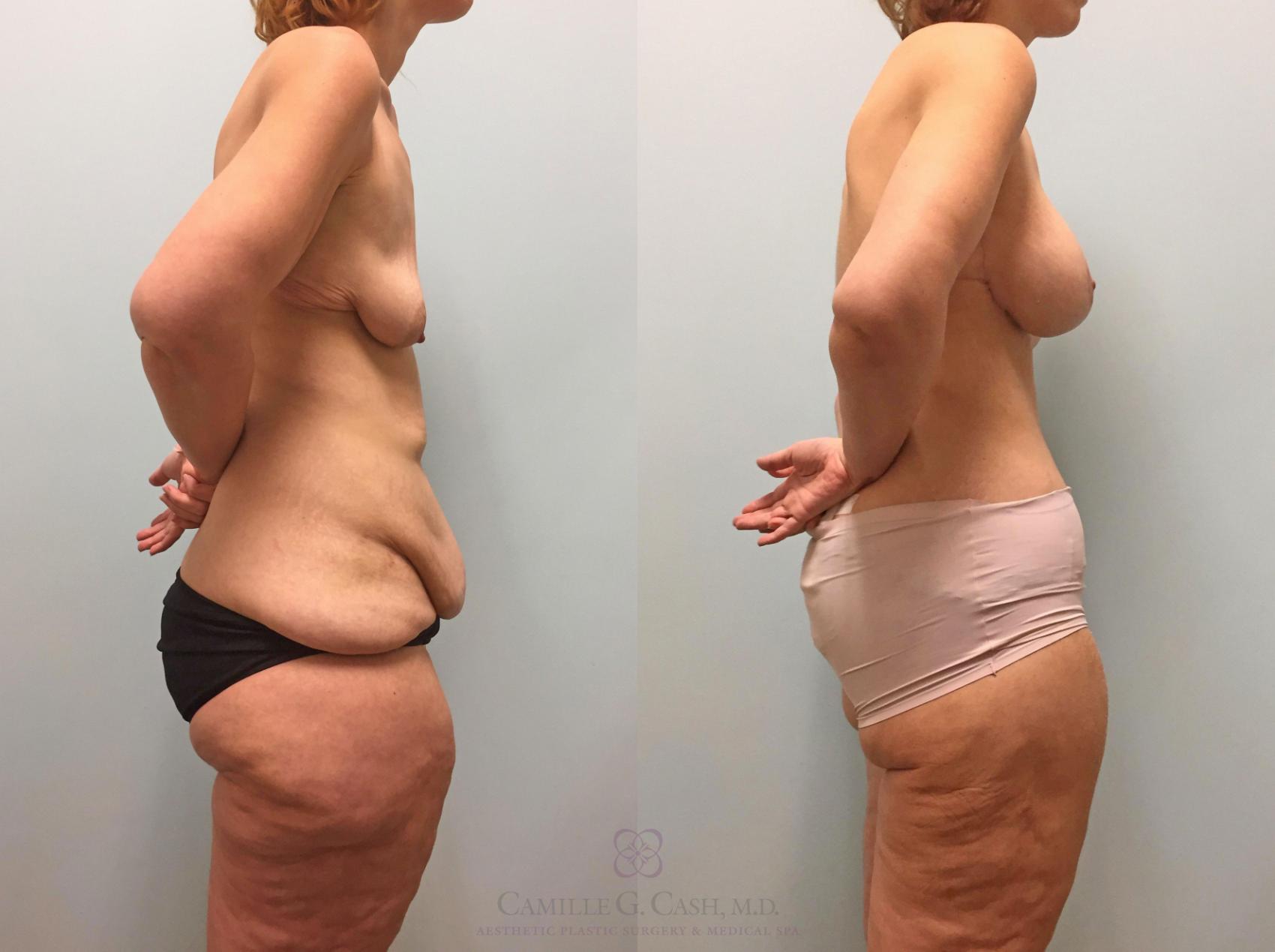 Before & After Arm Lift Case 232 View #4 View in Houston, TX