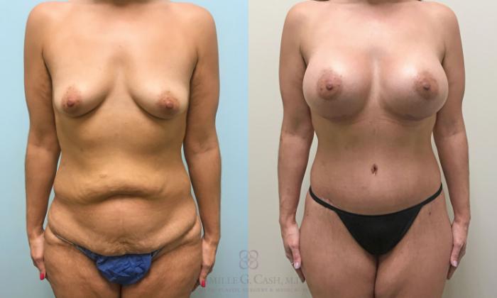 Before & After Post-Weight Loss Body Contouring Case 289 View #1 View in Houston, TX