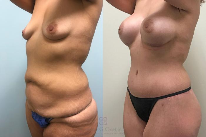 Before & After Post-Weight Loss Body Contouring Case 289 View #2 View in Houston, TX