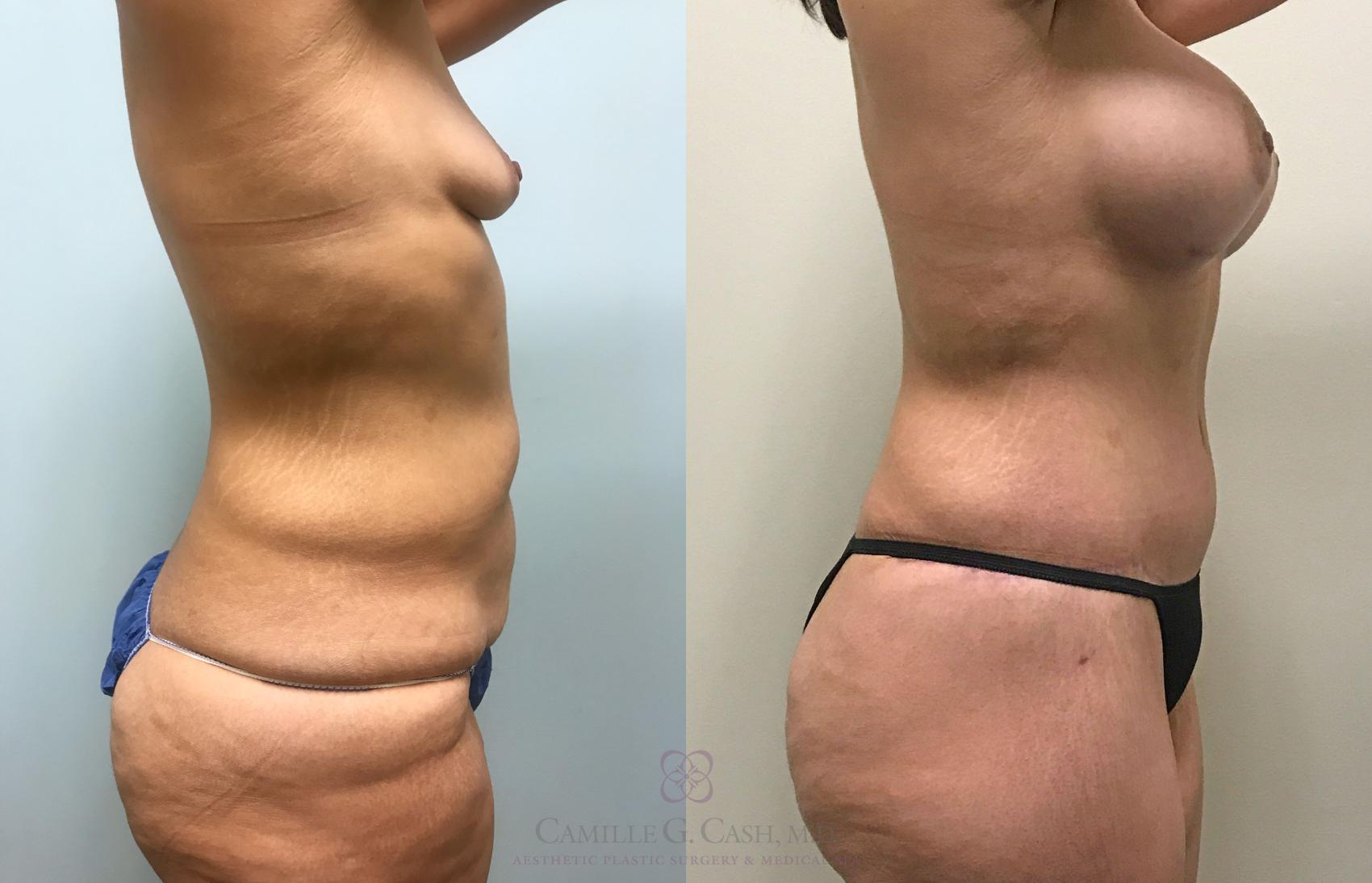 Before & After Post-Weight Loss Body Contouring Case 289 View #3 View in Houston, TX