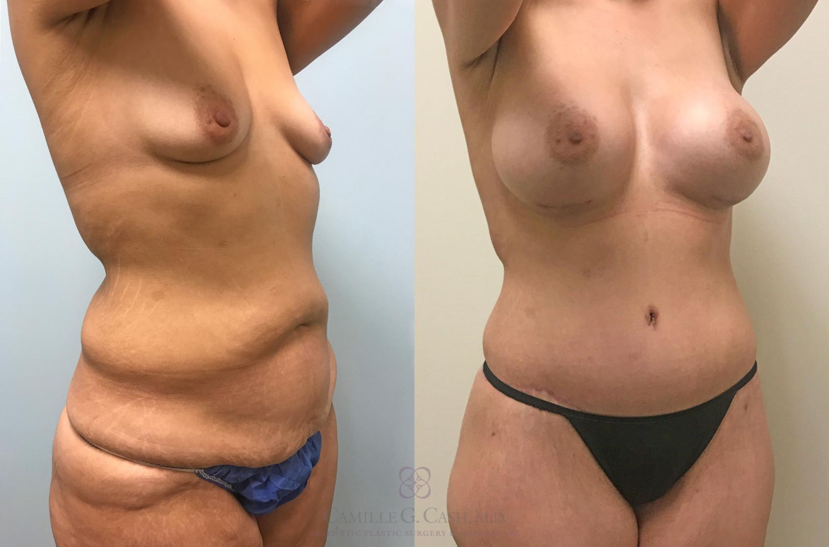 Before & After Post-Weight Loss Body Contouring Case 289 View #4 View in Houston, TX