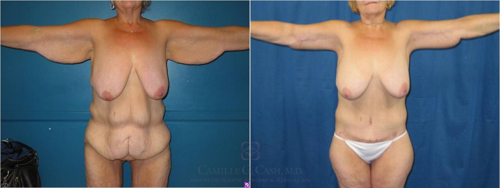 Before & After Post-Weight Loss Body Contouring Case 33 View #2 View in Houston, TX