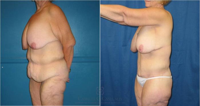 Before & After Post-Weight Loss Body Contouring Case 33 View #3 View in Houston, TX