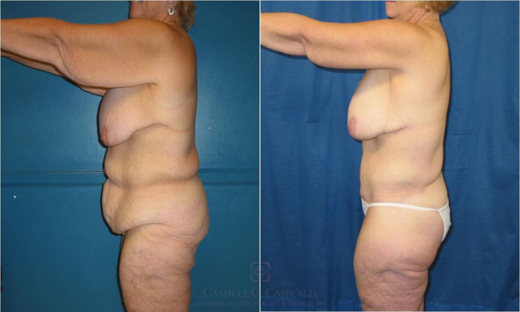 Before & After Post-Weight Loss Body Contouring Case 33 View #4 View in Houston, TX