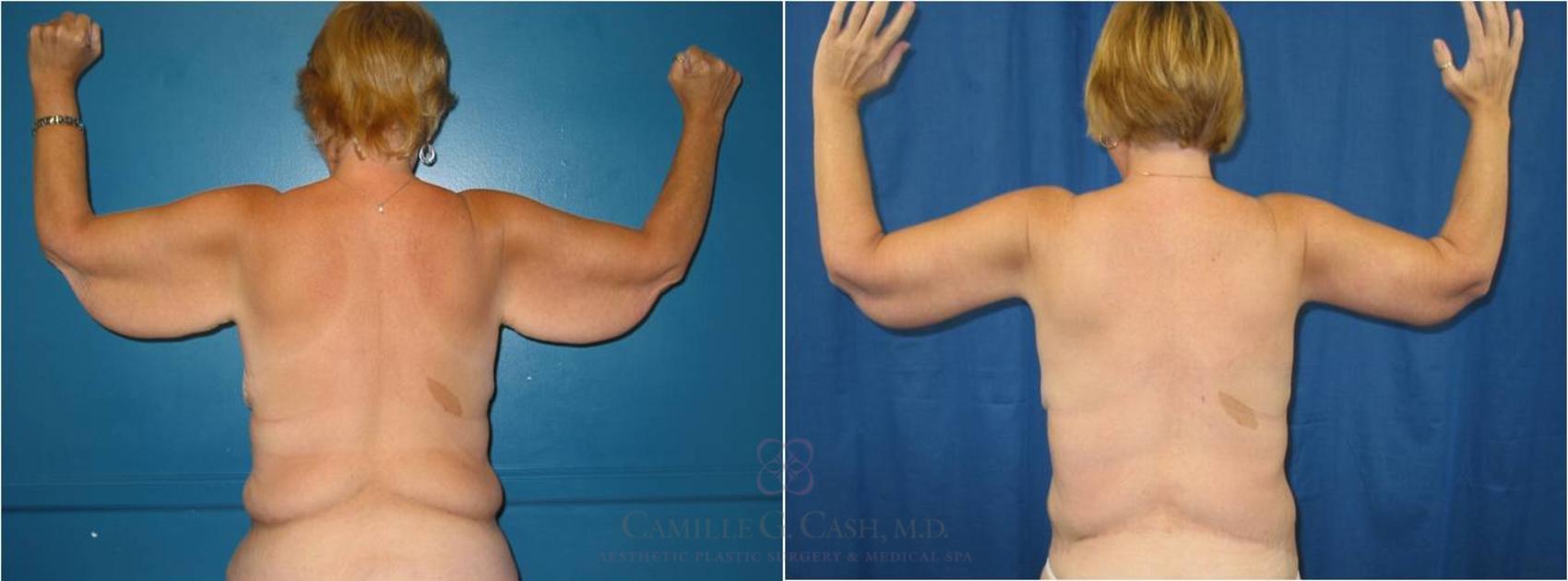 Before & After Arm Lift Case 33 View #5 View in Houston, TX