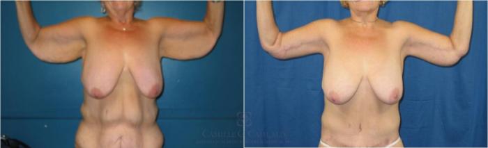 Before & After Post-Weight Loss Body Contouring Case 33 View #6 View in Houston, TX