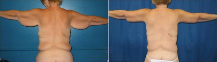 Before & After Body Lift Case 33 View #7 View in Houston, TX