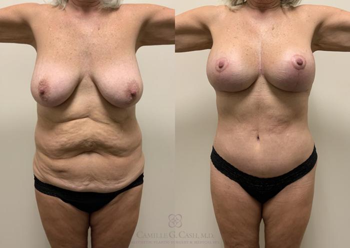 Before & After Post-Weight Loss Body Contouring Case 362 View #1 View in Houston, TX
