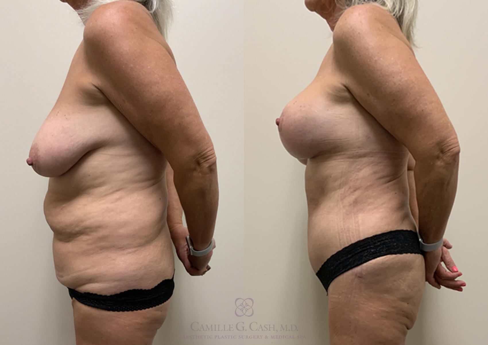 Before & After Post-Weight Loss Body Contouring Case 362 View #2 View in Houston, TX