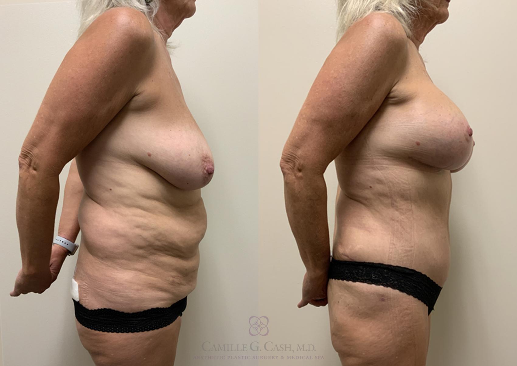Before & After Post-Weight Loss Body Contouring Case 362 View #3 View in Houston, TX