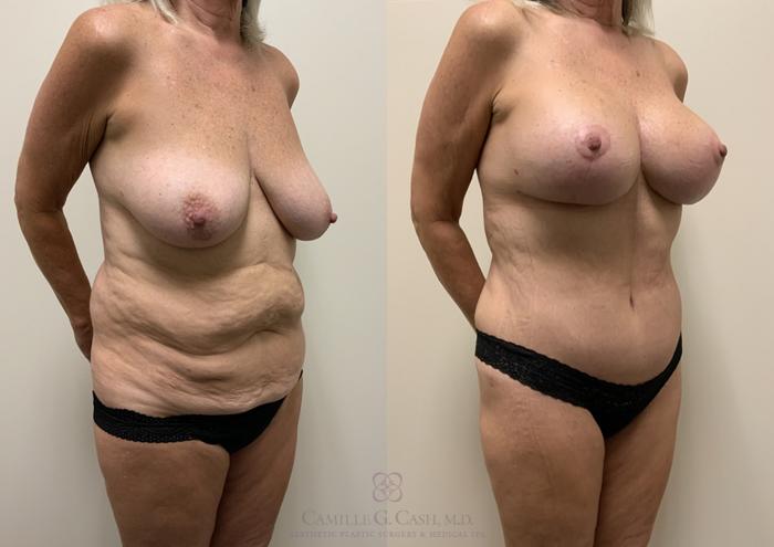 Before & After Post-Weight Loss Body Contouring Case 362 View #4 View in Houston, TX