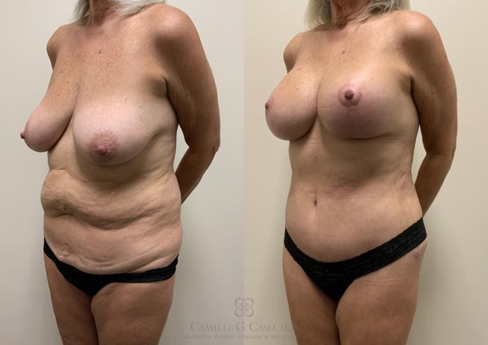 Before & After Post-Weight Loss Body Contouring Case 362 View #5 View in Houston, TX
