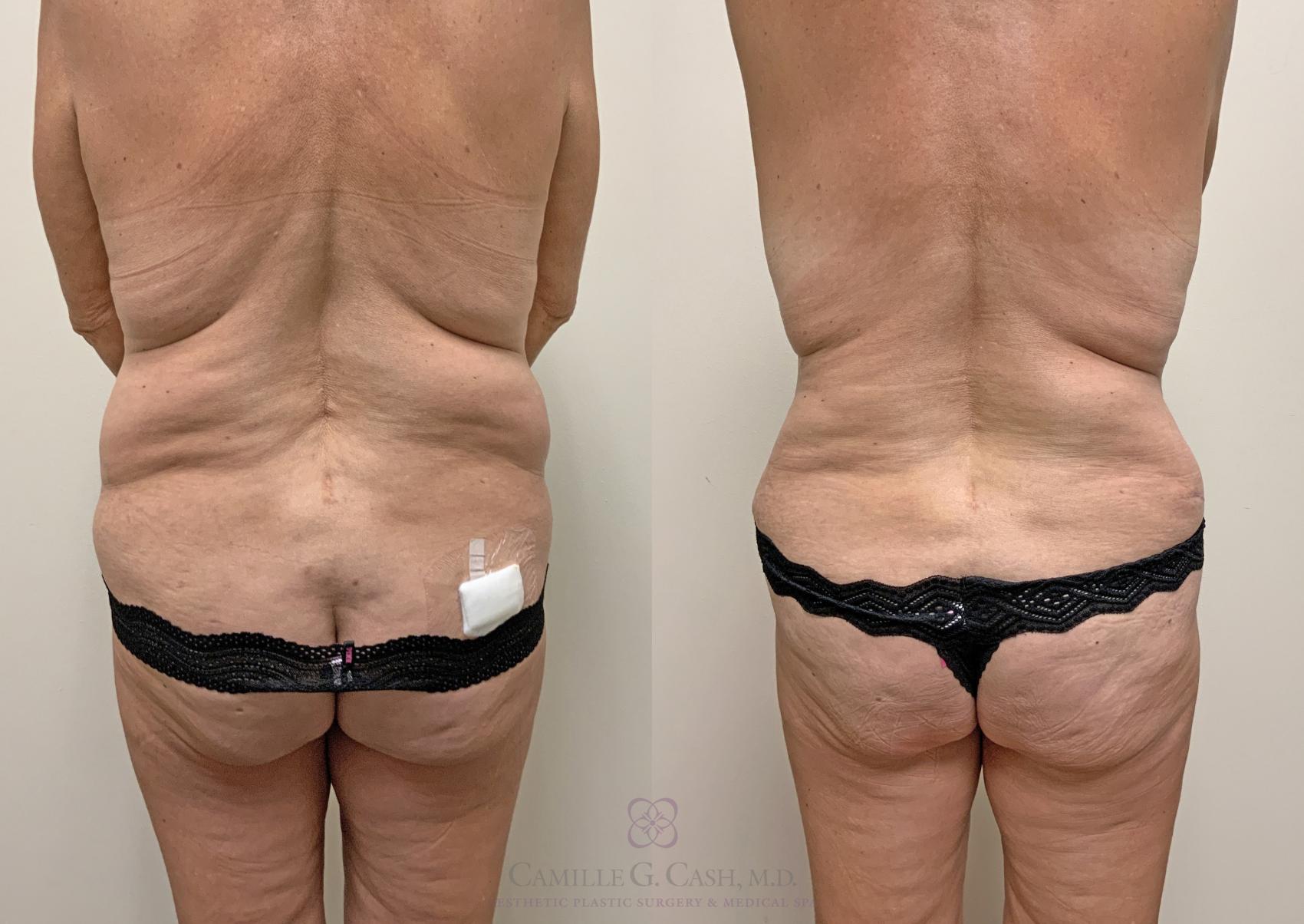 Before & After Post-Weight Loss Body Contouring Case 362 View #6 View in Houston, TX