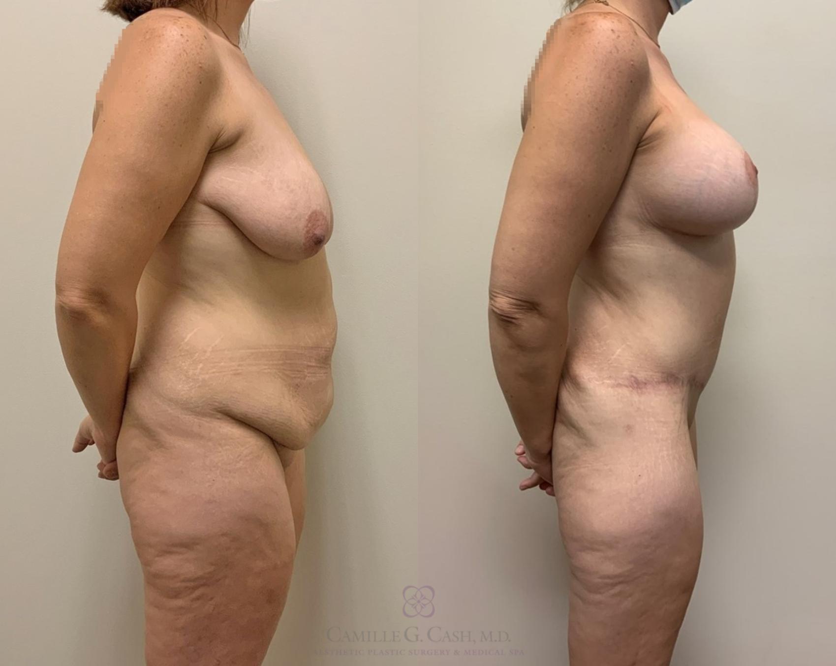 Before & After Post-Weight Loss Body Contouring Case 384 Left Side View in Houston, TX