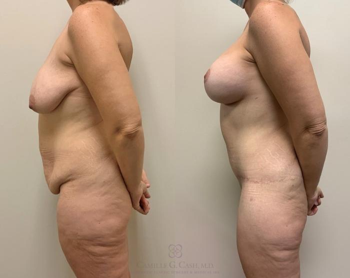 Before & After Post-Weight Loss Body Contouring Case 384 Right Side View in Houston, TX