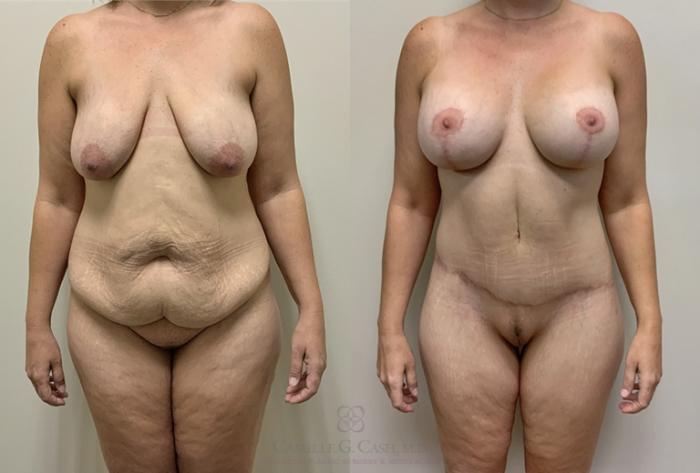 Before & After Post-Weight Loss Body Contouring Case 384 View #1 View in Houston, TX