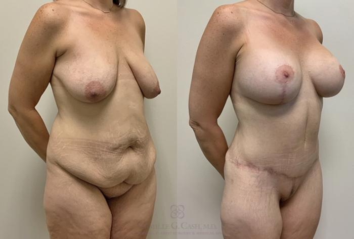 Before & After Post-Weight Loss Body Contouring Case 384 View #2 View in Houston, TX