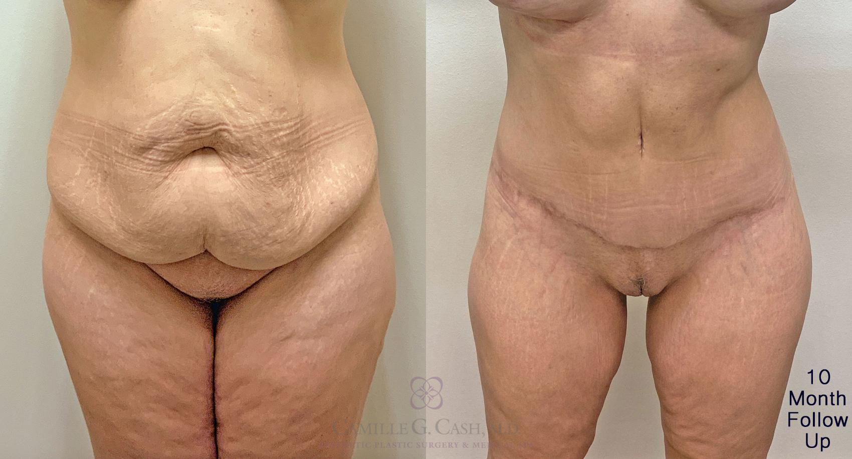 Before & After Post-Weight Loss Body Contouring Case 384 View #4 View in Houston, TX