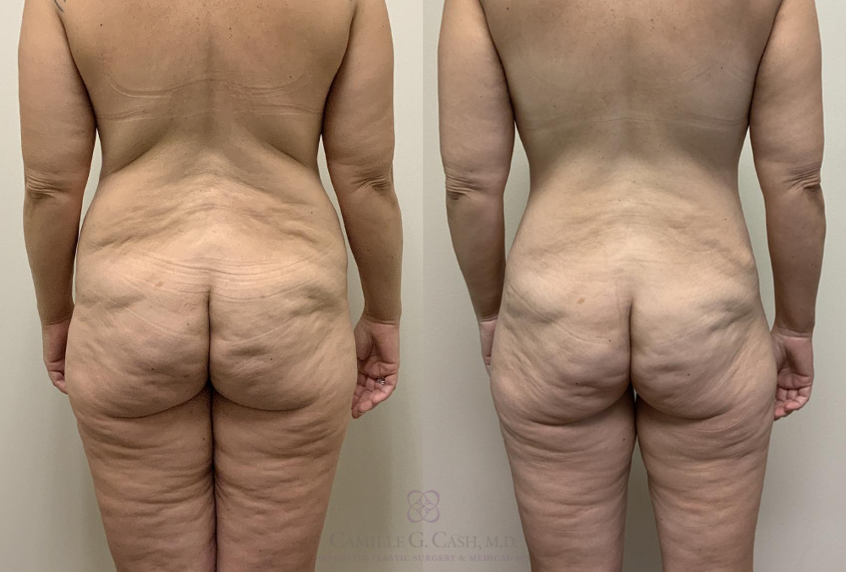 Before & After Post-Weight Loss Body Contouring Case 384 View #5 View in Houston, TX