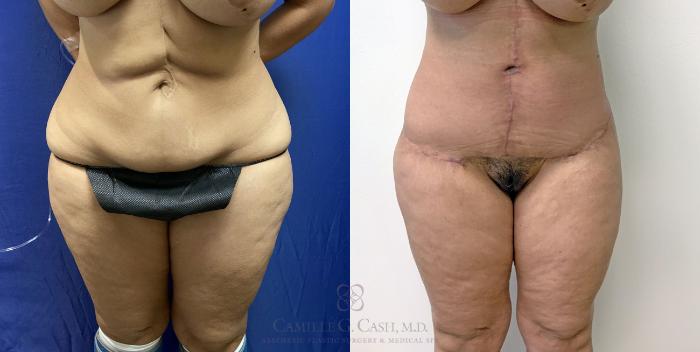 Before & After Post-Weight Loss Body Contouring Case 405 View #1 View in Houston, TX