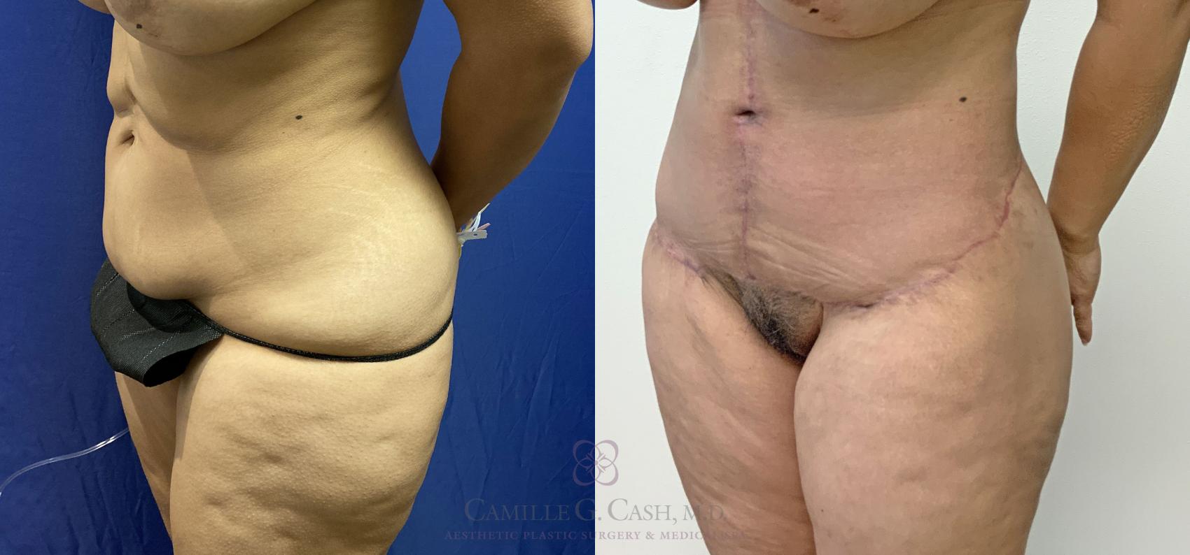 Before & After Post-Weight Loss Body Contouring Case 405 View #2 View in Houston, TX