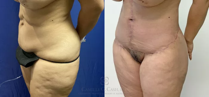 What is a Fleur de Lis Tummy Tuck- Dr Luis Suarez MD