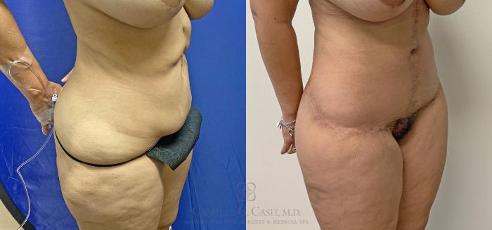 Before & After Post-Weight Loss Body Contouring Case 405 View #3 View in Houston, TX
