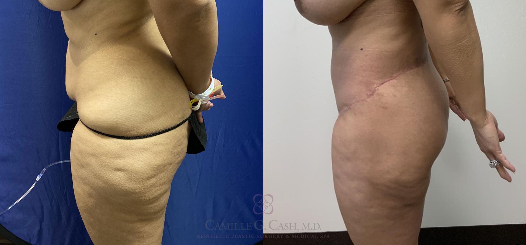 Before & After Post-Weight Loss Body Contouring Case 405 View #4 View in Houston, TX