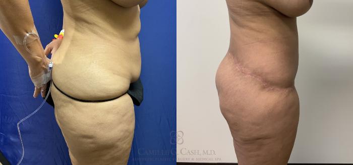 Before & After Post-Weight Loss Body Contouring Case 405 View #5 View in Houston, TX