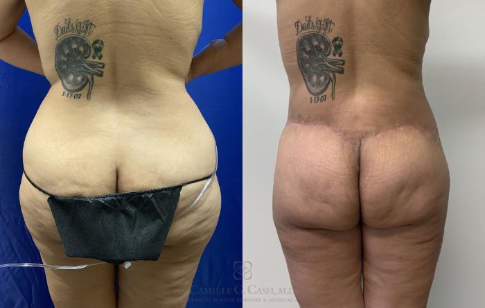 Before & After Post-Weight Loss Body Contouring Case 405 View #6 View in Houston, TX