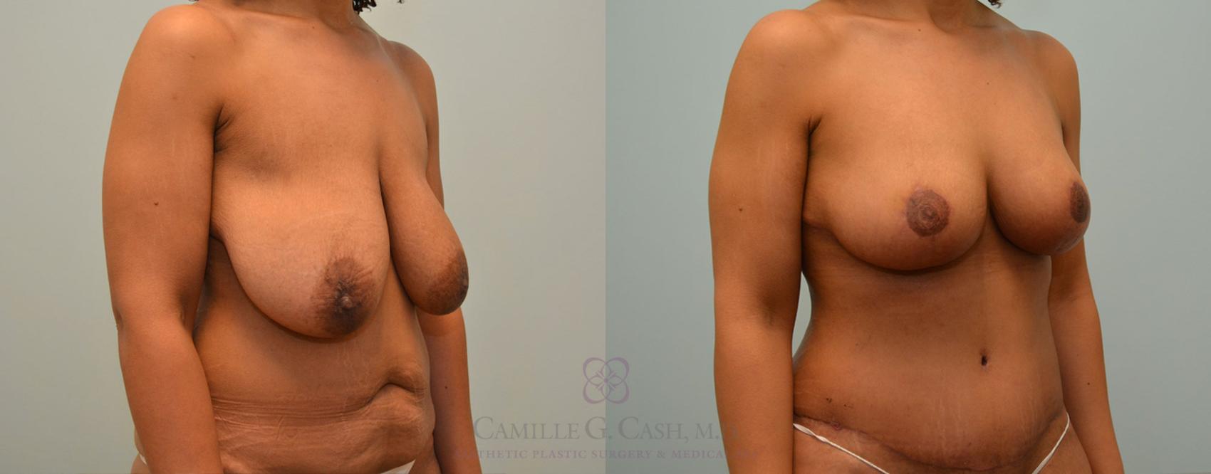 Before & After Breast Lift Case 426 View #1 View in Houston, TX