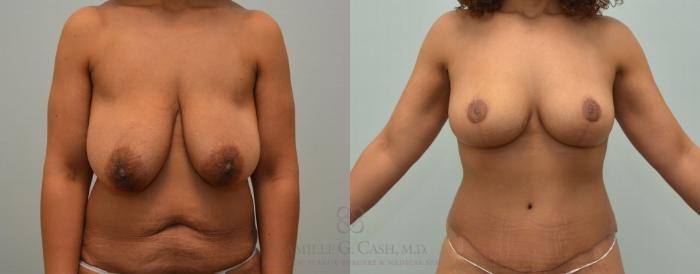 Before & After Breast Lift Case 426 View #2 View in Houston, TX