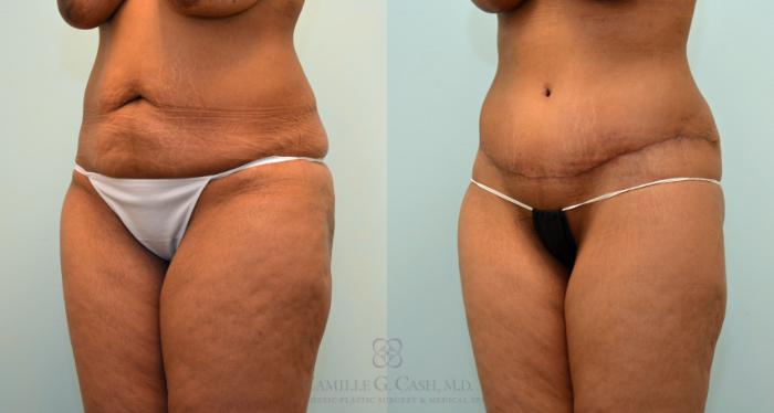 Before & After Post-Weight Loss Body Contouring Case 426 View #3 View in Houston, TX