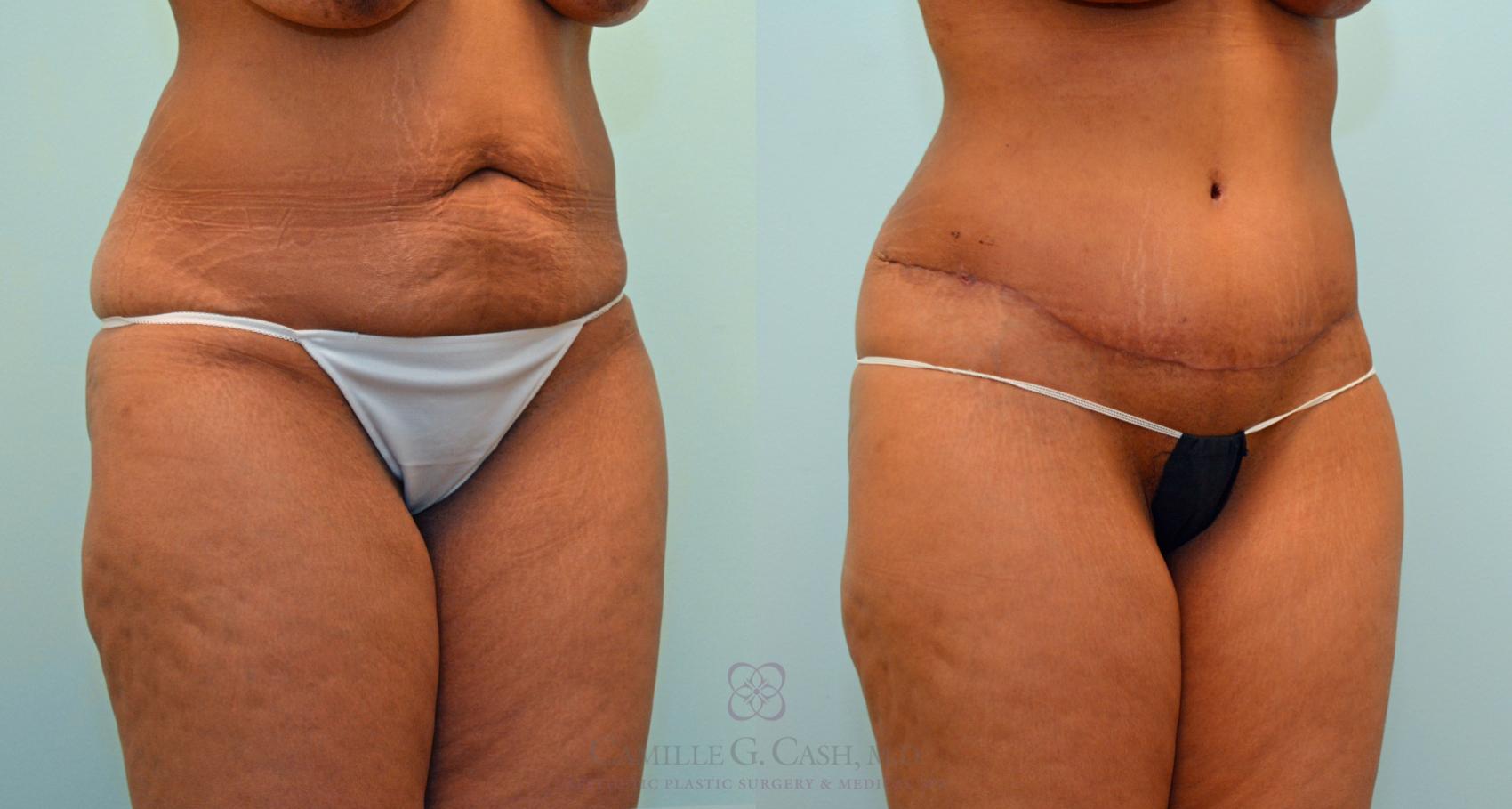 Before & After Post-Weight Loss Body Contouring Case 426 View #4 View in Houston, TX