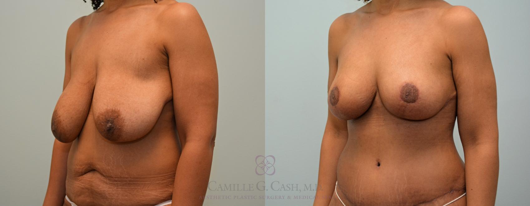 Before & After Post-Weight Loss Breast Enhancement Case 426 View #5 View in Houston, TX